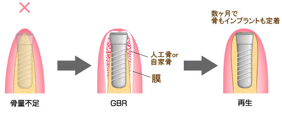 GBR（骨再生誘導療法）のしくみ